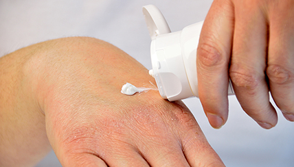 discoid eczema treatment